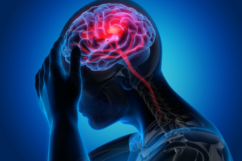 The lowdown on migraines